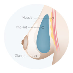 prothese-glande-mammaire