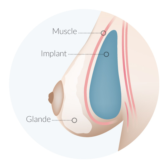 prothese-muscle-pectoral