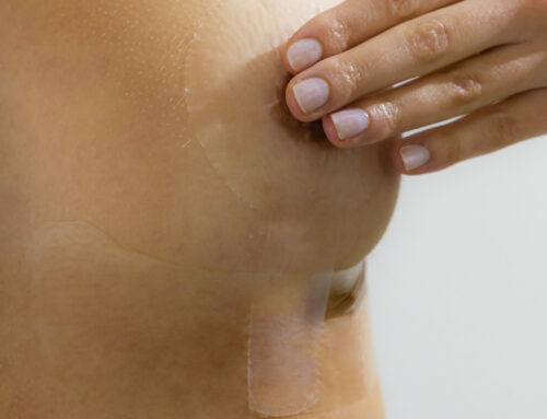 Que prévoir après une chirurgie mammaire, zoom sur nos produits partenaires : 1ère partie, le pansement siliconé CEREDERM®