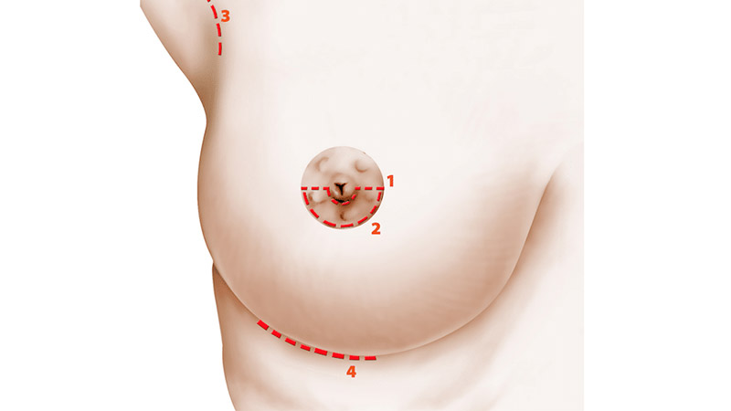 Cicatrice-mammaire